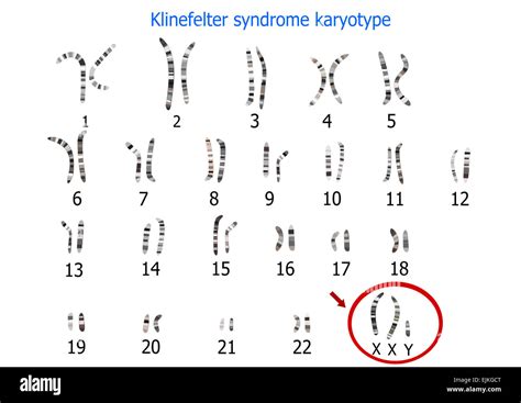 Sindrome di Klinefelter Cariotipo 47XXY