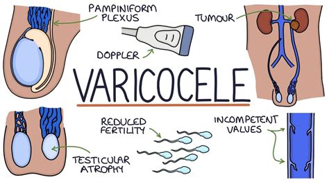 Rappresentazione di un Varicocele