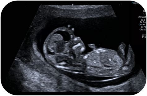 rappresentazione grafica di una ecografia ostetrica durante il primo trimestre