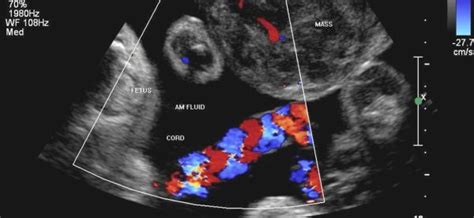 Ecografia fetale con flusso Doppler