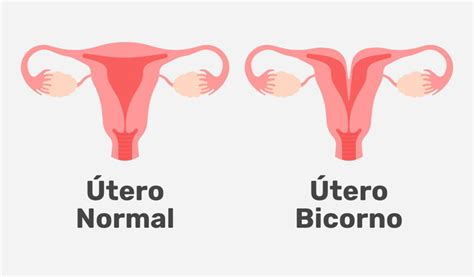 Rappresentazione anatomica comparata: utero normale vs utero bicorne