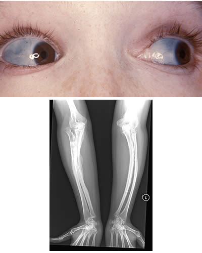 Sclere blu in osteogenesi imperfetta