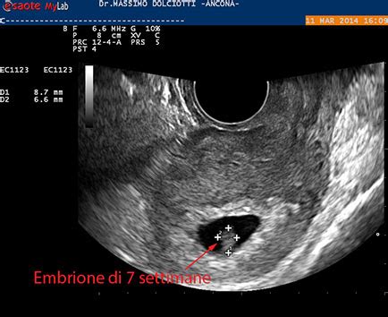 Embrione di 7 settimane