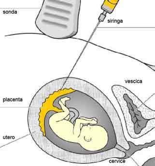 Differenza tra Villocentesi e Amniocentesi