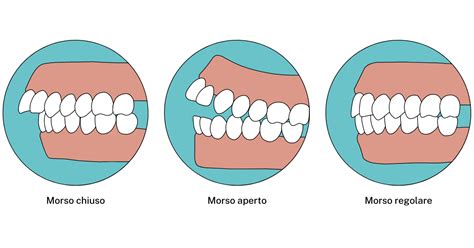 Illustrazione di un morso aperto anteriore
