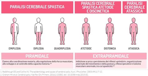 schema grafico dei diversi tipi di paralisi cerebrale e distribuzione corporea