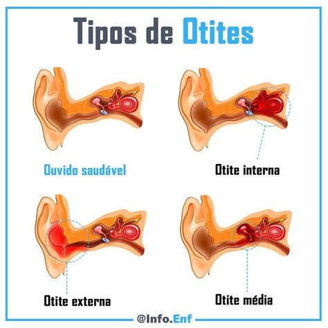 Tipi di otite