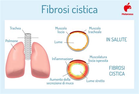 Diagramma degli organi colpiti dalla fibrosi cistica