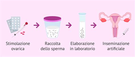 Schema della procedura di inseminazione artificiale