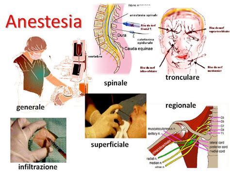 diagramma dei tipi di anestesia