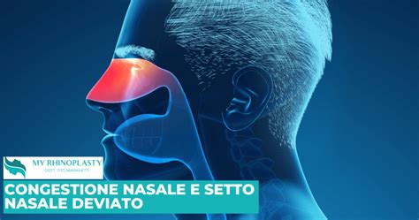 Diagramma che illustra le diverse tipologie di ostruzione nasale congenita