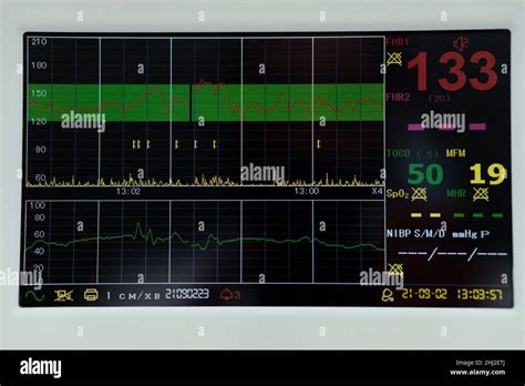 schema grafico del monitoraggio fetale e della cardiotocografia
