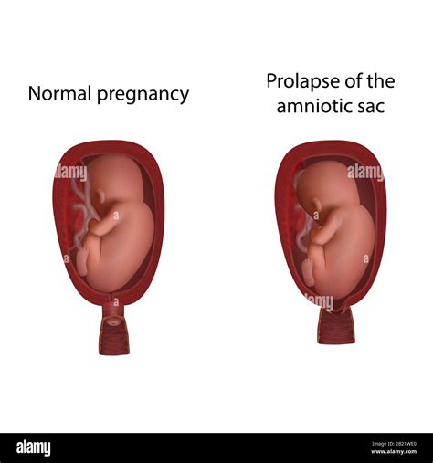 Illustrazione del sacco amniotico e del feto nell'utero