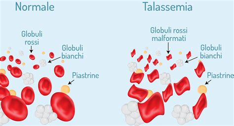 Confronto tra globuli rossi sani e affetti da talassemia