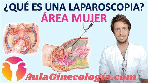 Laparoscopia ginecologica