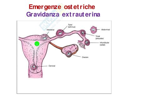 Schema di una gravidanza extrauterina