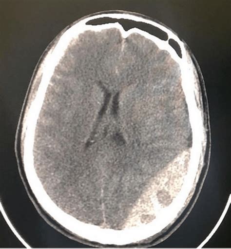 confronto radiologico tra ematoma epidurale a lente biconvessa e ematoma subdurale semilunare