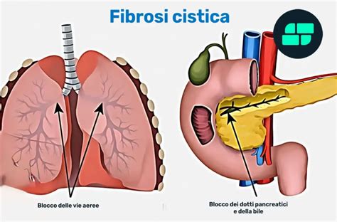 Immagine composita che mostra gli organi colpiti dalla fibrosi cistica