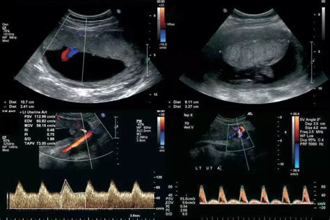 schema del funzionamento della velocimetria Doppler in gravidanza