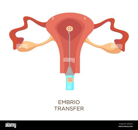 Trasferimento embrionale in utero