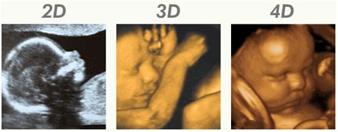 Ecografia fetale 2D, 3D e 4D