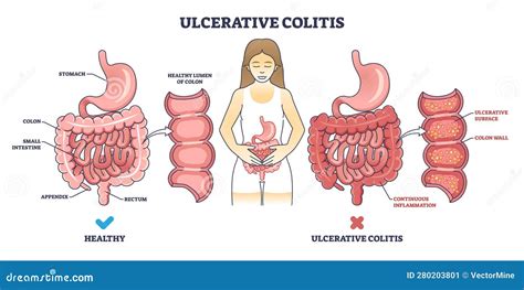 Schema vie gastrointestinali con ulcere