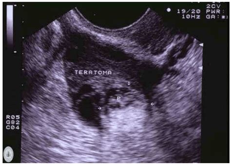 Immagine ecografica di residui endometriali post-aborto