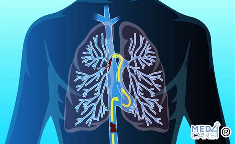 Schema che illustra il percorso di un embolo polmonare