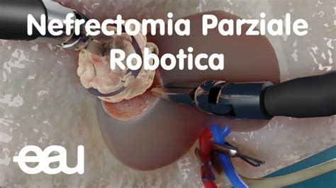 Schema della nefrectomia parziale per preservare il rene