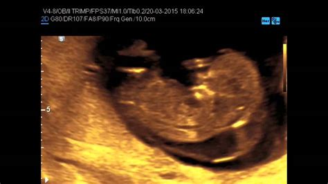 Ecografia fetale che mostra un igroma cistico nucale