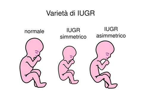 Diagramma che illustra IUGR simmetrico e asimmetrico