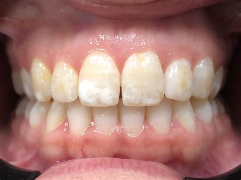 Immagine che mostra diversi gradi di fluorosi dentale su smalto