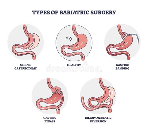 Schema dietetico post-operatorio chirurgia bariatrica