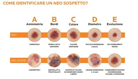 Esame dermoscopico di un nevo sospetto
