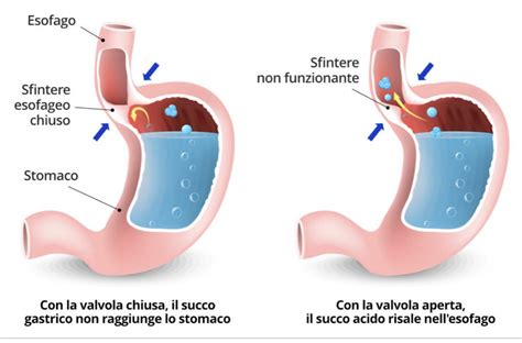 Diagramma dell'esofago e dello stomaco con enfasi sullo sfintere esofageo inferiore