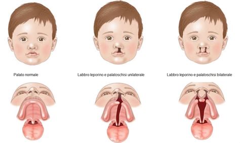 Infografica sui difetti alla nascita comuni associati al topiramato (labbro leporino, palatoschisi, ipospadia)