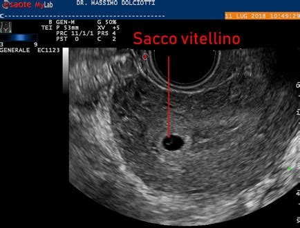 Ecografia di camera gestazionale e sacco vitellino