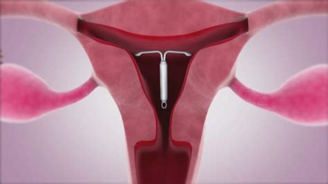 schema del posizionamento della spirale uterina