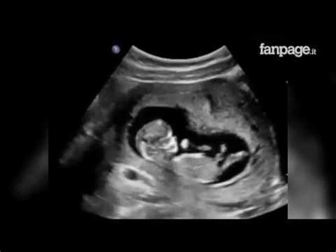 Ecografia di un feto nella pancia della madre