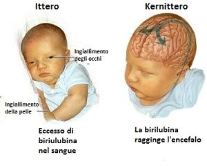 neonato con ittero