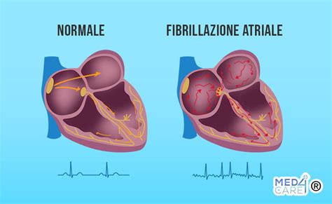 rappresentazione schematica dell'attività elettrica caotica in un cuore affetto da fibrillazione ventricolare