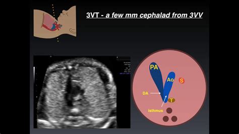 schema della scansione 3-vasi-trachea (3VT) fetale