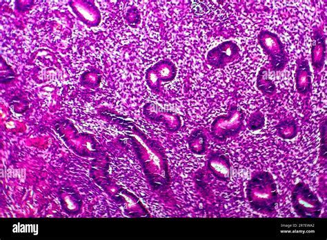 Tessuto endometriale fuori dall'utero
