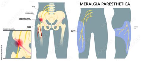 Illustrazione di un esame fisico per la meralgia parestesica