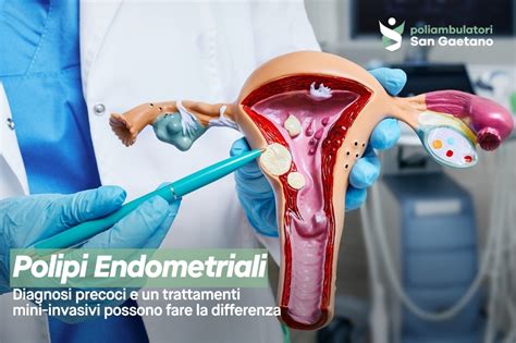 rappresentazione schematica dell'utero e posizionamento di un polipo endometriale