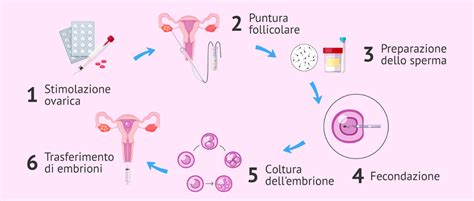 diagramma che illustra le fasi della PMA: stimolazione, prelievo, fecondazione e transfer