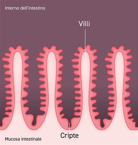 diagramma che illustra la struttura delle cripte tonsillari e l'azione dei linfociti contro i batteri
