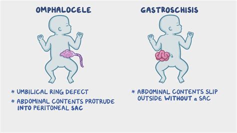 Confronto visivo tra Onfalocele e Gastroschisi