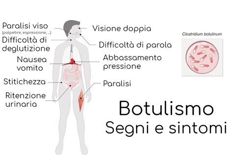 Bambino con sintomi di botulismo