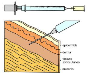 Schema dei siti di iniezione sottocutanea